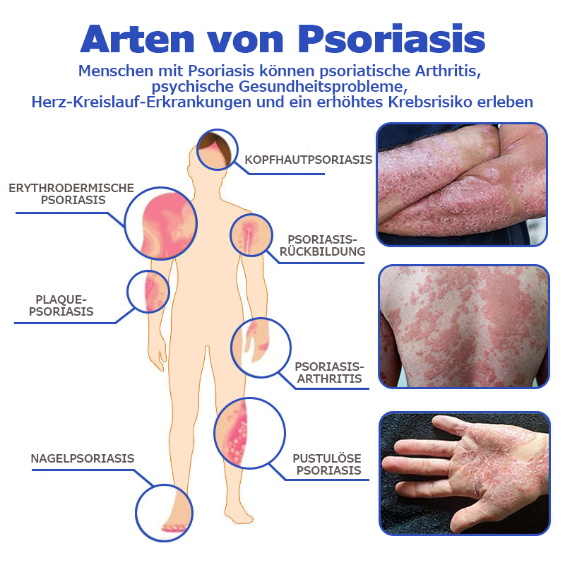 🌞Furzero™ OceanCure Bienengift Psoriasis und Warzen Heilcreme