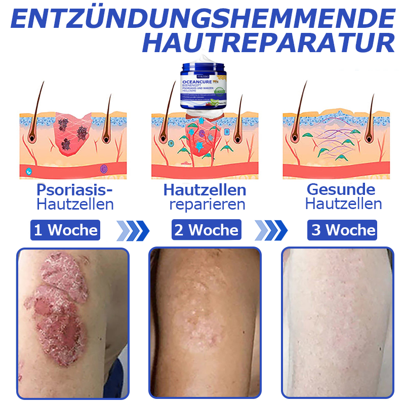 🌞Furzero™ OceanCure Bienengift Psoriasis und Warzen Heilcreme