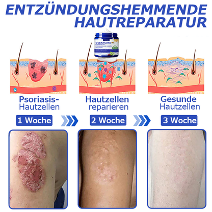 🌞Furzero™ OceanCure Bienengift Psoriasis und Warzen Heilcreme