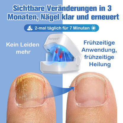 Furzero™ Nagelpilz-Laserbehandlungsgerät