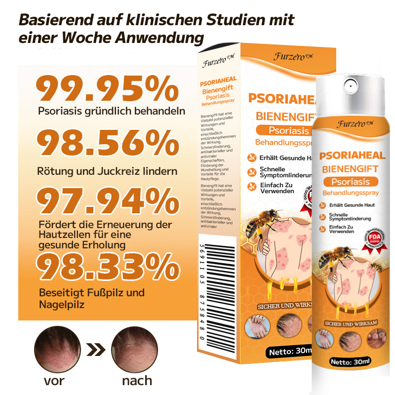 Furzero™ PsoriaHeal Bienengift Psoriasis Behandlungsspray(Geeignet für alle Hauttypen)