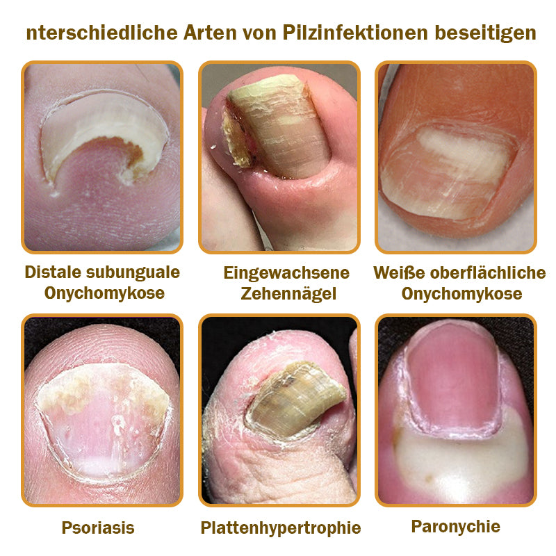 🐝Furzero™ Nagelverteidigung Bienengift-Behandlungsserum