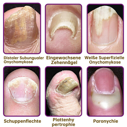 🐝flysmus™ FungiFree Bienengift Nagelbehandlungsserum