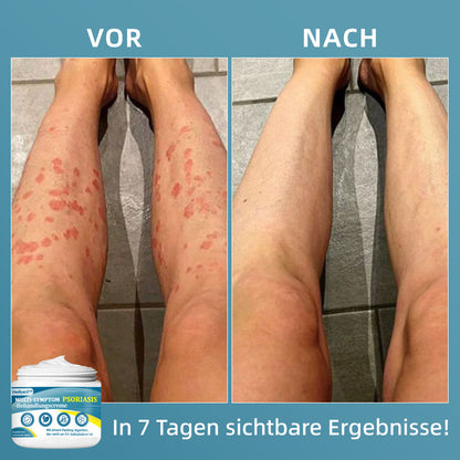 Ourlyard™  Multi-Symptom Psoriasis-Behandlungscreme（👨‍⚕Vom Arzt empfohlen）