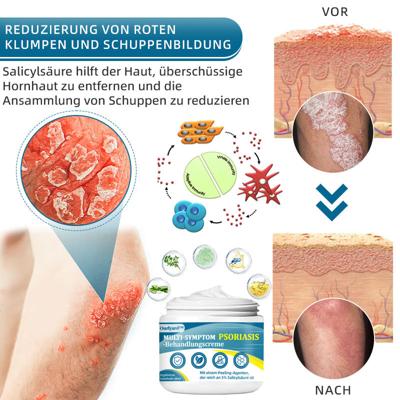 Ourlyard™  Multi-Symptom Psoriasis-Behandlungscreme（👨‍⚕Vom Arzt empfohlen）