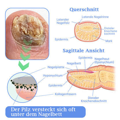 Furzero™ PureNailRENEW Lasertherapie Set