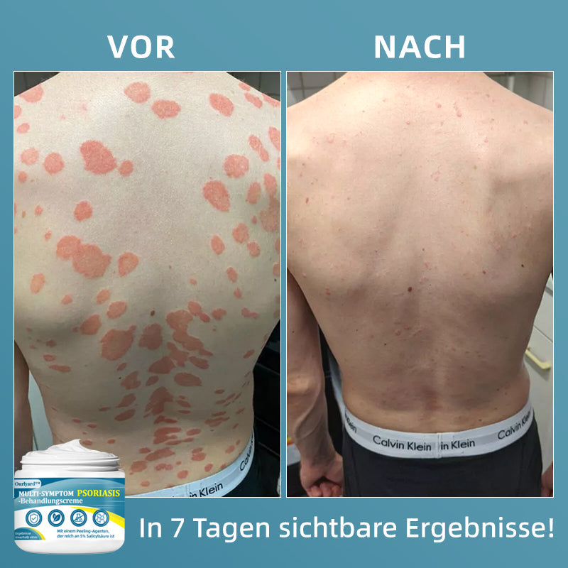 Ourlyard™  Multi-Symptom Psoriasis-Behandlungscreme（👨‍⚕Vom Arzt empfohlen）