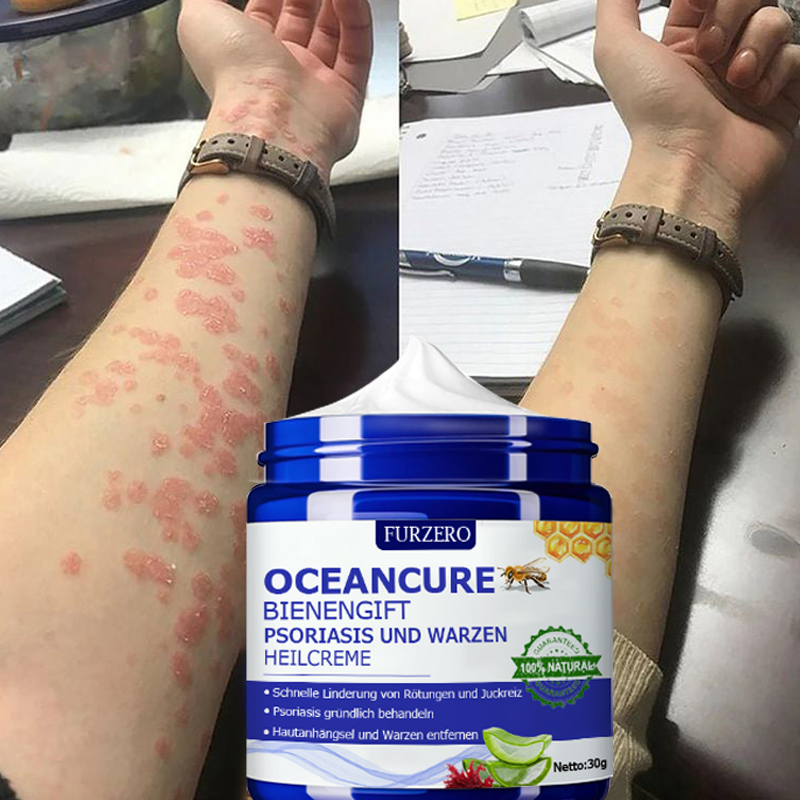 🌞Furzero™ OceanCure Bienengift Psoriasis und Warzen Heilcreme