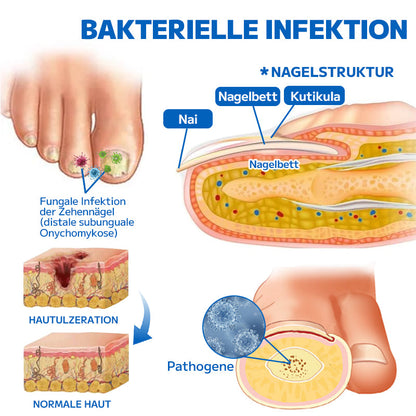 🔥 Furzero™ Nagelpilz-Fußspray