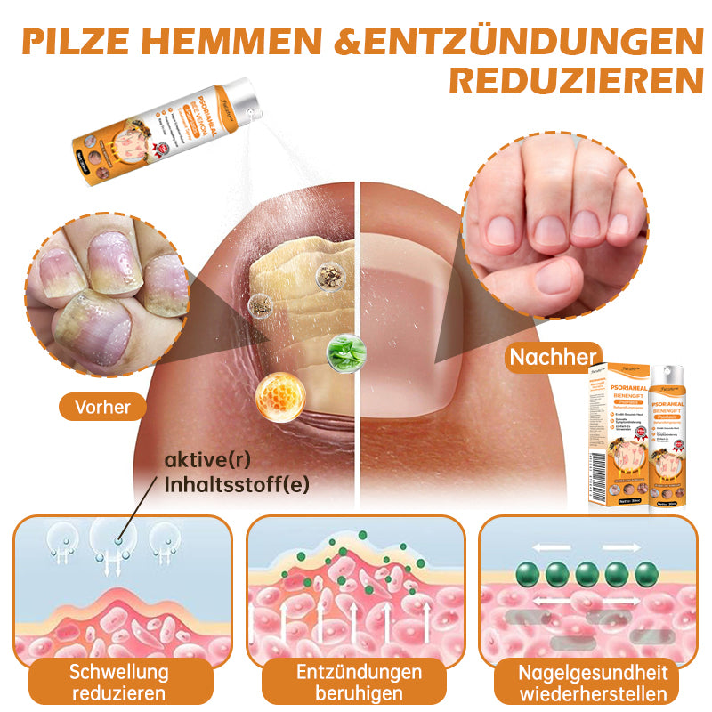 Furzero™ PsoriaHeal Bienengift Psoriasis Behandlungsspray(Geeignet für alle Hauttypen)