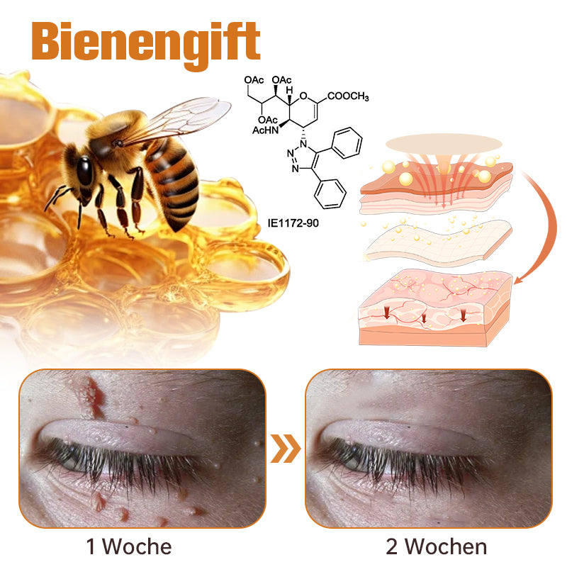 Ourlyard™  WartGone Bienengift-Behandlungspflaster