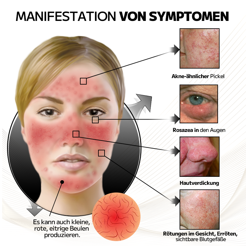 Ourlyard™ Laserbehandlungsmaske für Rosacea