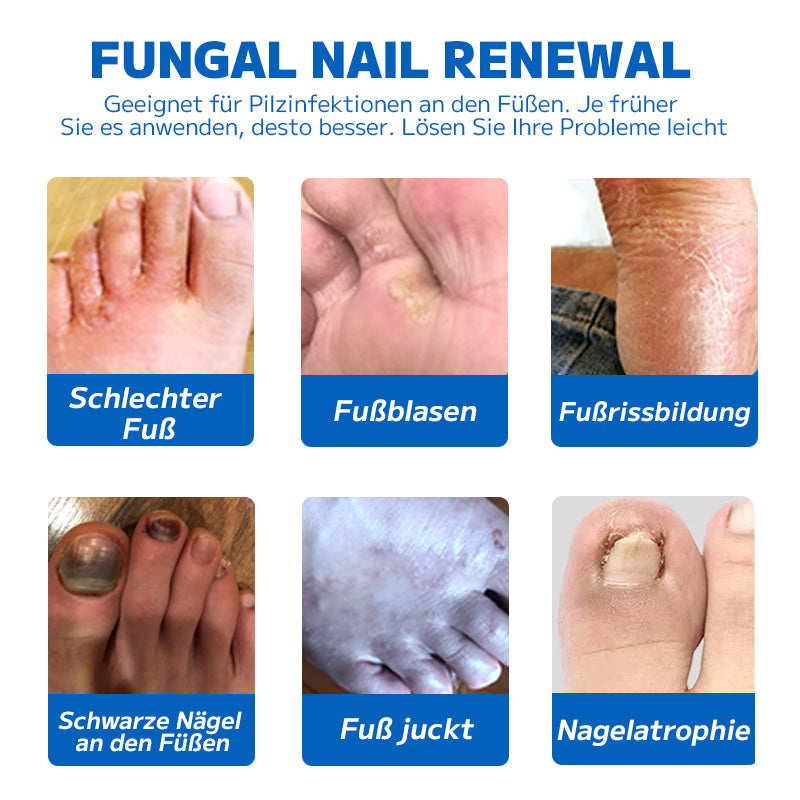 🔥 Furzero™ Nagelpilz-Fußspray