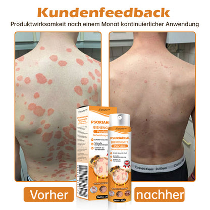 Furzero™ PsoriaHeal Bienengift Psoriasis Behandlungsspray(Geeignet für alle Hauttypen)