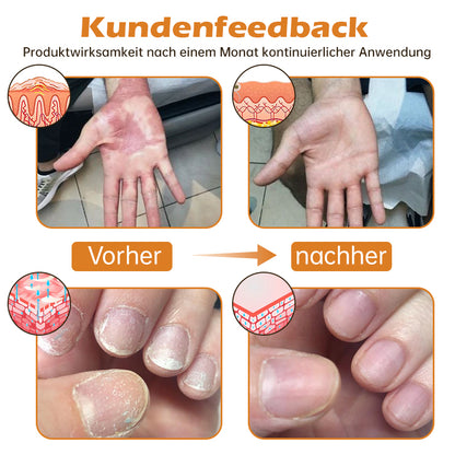 👍🐝Furzero™ PsoriaHeal Bienengift Psoriasis Behandlungsspray(Geeignet für alle Hauttypen)