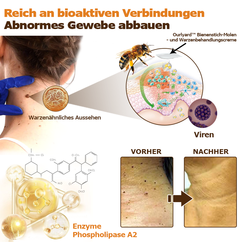 🐝Ourlyard™ Bienen Gift Warzen- und Muttermalbehandlungscreme