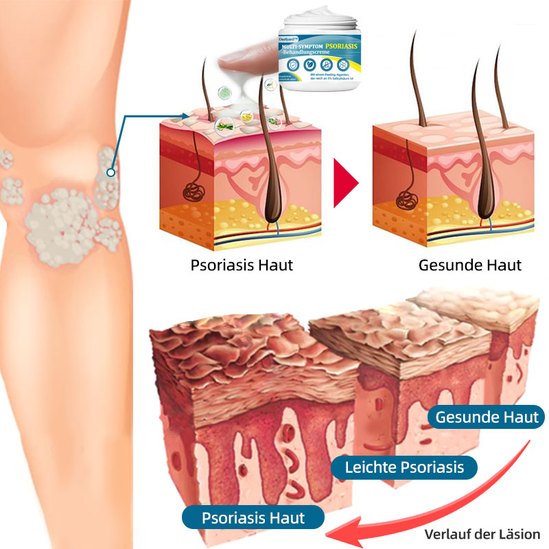 Ourlyard™  Multi-Symptom Psoriasis-Behandlungscreme（👨‍⚕Vom Arzt empfohlen）