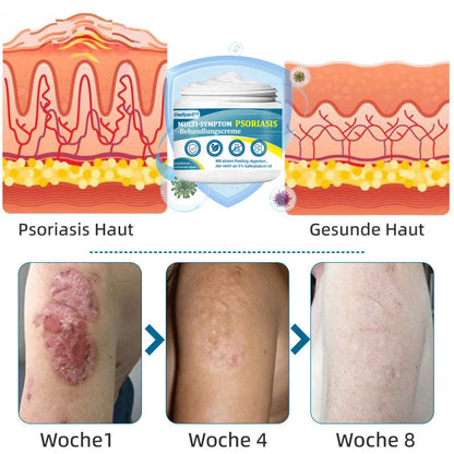 Ourlyard™  Multi-Symptom Psoriasis-Behandlungscreme（👨‍⚕Vom Arzt empfohlen）