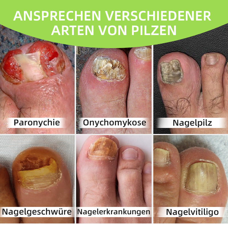 🍀Furzero™ Nagelpilz-Laserbehandlungsgerät🍀